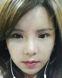 更美 - 更美用户ejJuxMDpUo的膨体隆鼻经验 | 膨体隆鼻 | 莆田