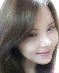 更美 - 更美用户ejJuxMDpUo的膨体隆鼻经验 | 膨体隆鼻 | 莆田