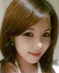 更美 - 更美用户ejJuxMDpUo的膨体隆鼻经验 | 膨体隆鼻 | 莆田