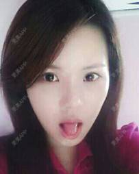 更美 - 更美用户ejJuxMDpUo的膨体隆鼻经验 | 膨体隆鼻 | 莆田