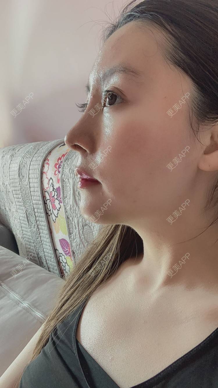 肋软骨隆鼻效果图_术后14天__更美