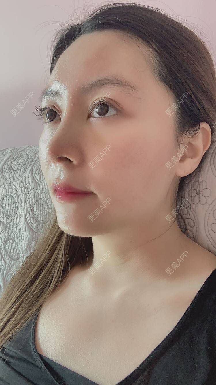 璐璐娜娜的肋软骨隆鼻日记