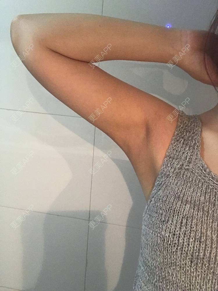 瘦成一道闪电737373的手臂吸脂日记