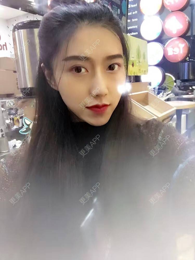 更美 - 更美用户ZXEbAlpKTV的双下巴溶脂经验 | 双下巴溶脂