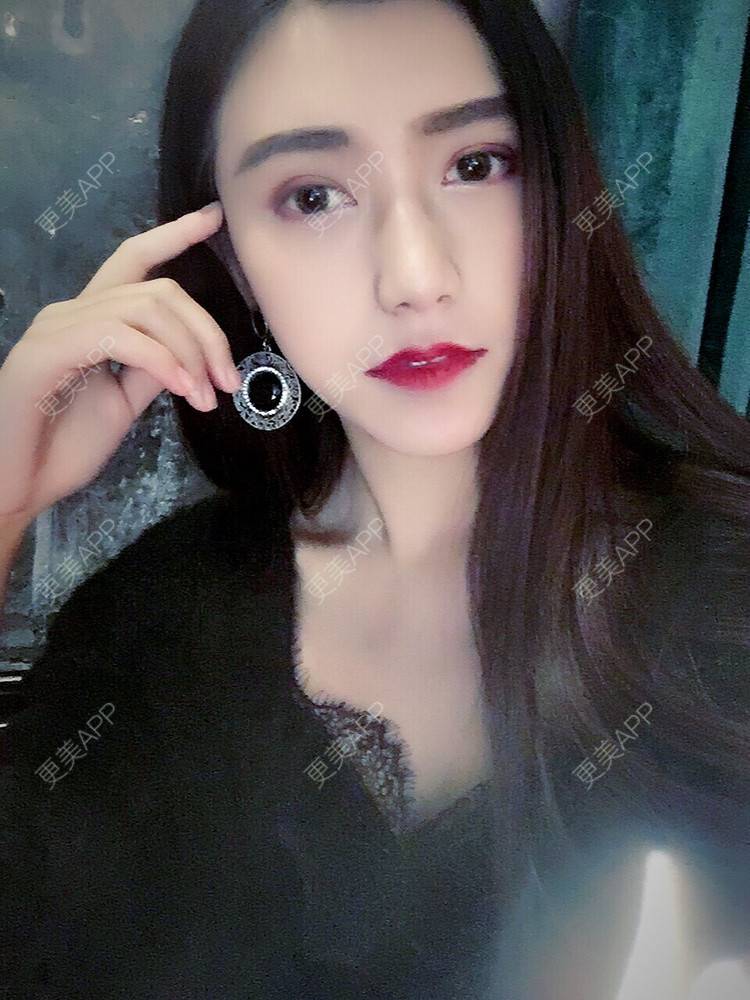 更美 - 更美用户ZXEbAlpKTV的双下巴溶脂经验 | 双下巴溶脂