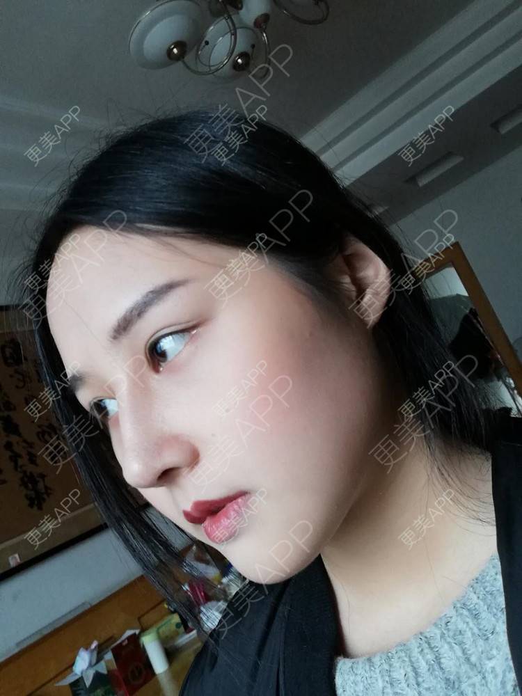 更美用户vwoogsiqyr的鼻综合日记