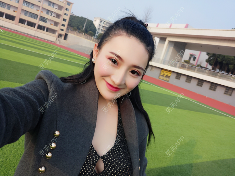 更美 - 更美用户vUOf7IO6ke的玻尿酸卧蚕经验 | 玻尿酸卧蚕