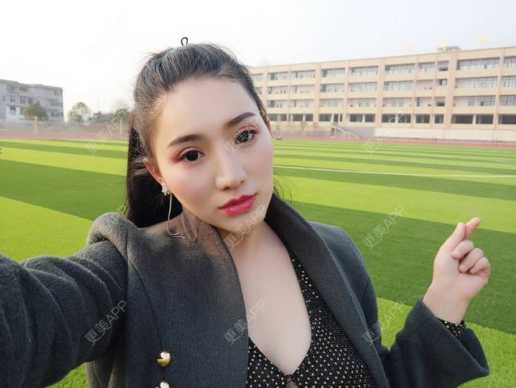 更美 - 更美用户vUOf7IO6ke的玻尿酸卧蚕经验 | 玻尿酸卧蚕