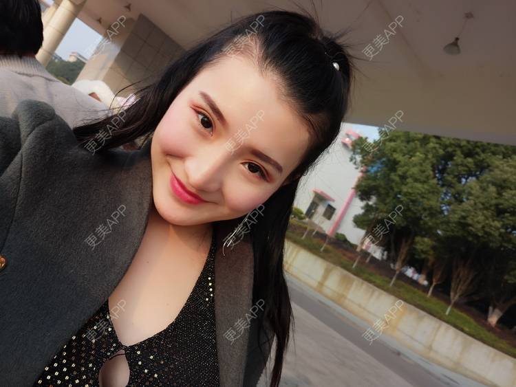 更美 - 更美用户vUOf7IO6ke的玻尿酸卧蚕经验 | 玻尿酸卧蚕