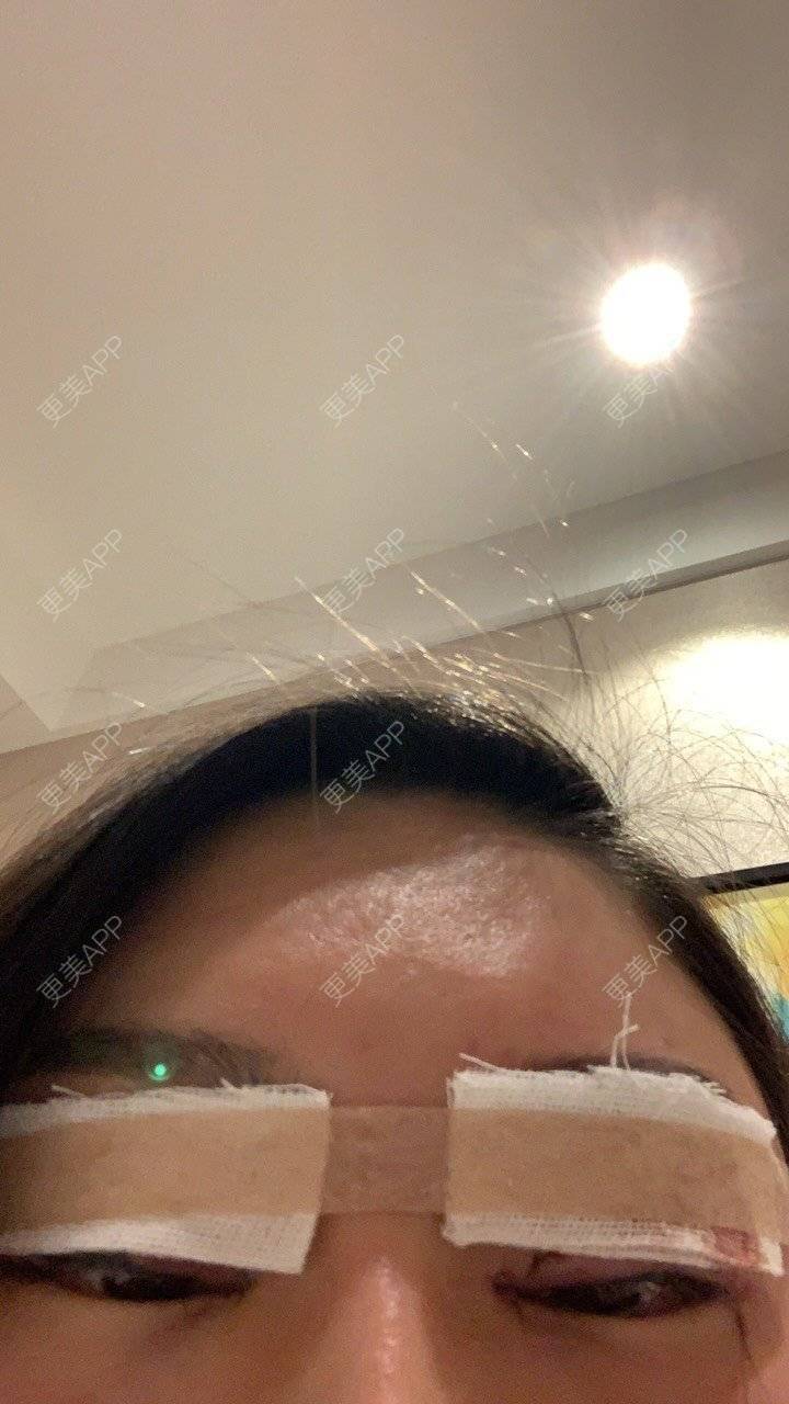更美 - Angela816的双眼皮经验 | 双眼皮 | 全切双眼皮 | 绍兴