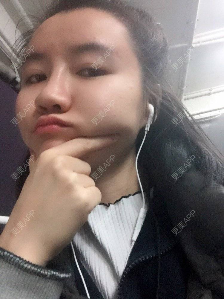 更美 - fhrhjtjth的近视矫正经验 | 深圳 | 近视矫正
