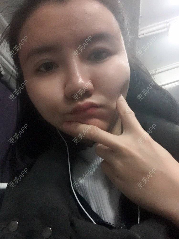 更美 - fhrhjtjth的近视矫正经验 | 深圳 | 近视矫正