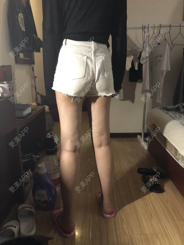 温酒与卿书的吸脂瘦大腿日记