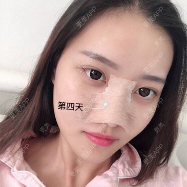 隆鼻