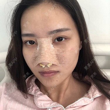 隆鼻