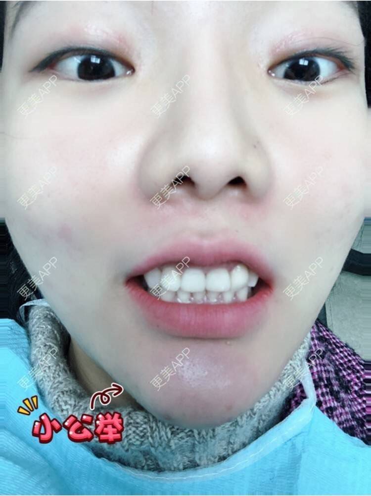 更美 - 更美用户HktsdssB56的牙贴面经验 | 成都 | 牙贴面 | 牙齿瓷贴面