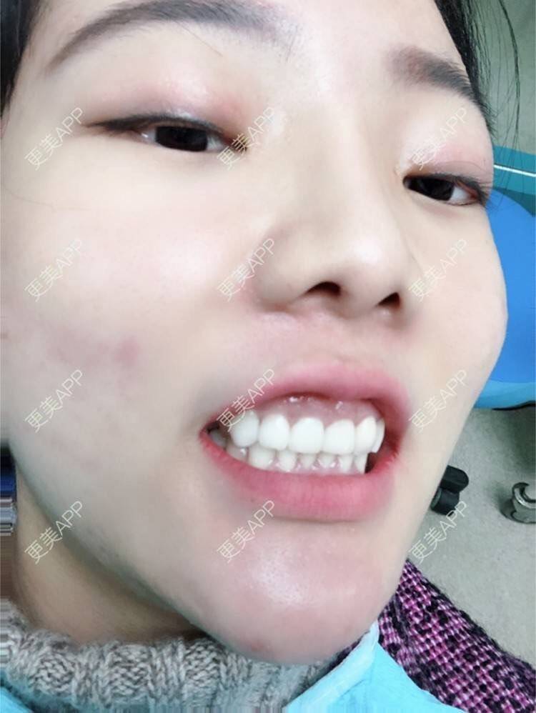 更美 - 更美用户HktsdssB56的牙贴面经验 | 成都 | 牙贴面 | 牙齿瓷贴面