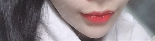 更美 - 更美用户yLBEhTSwEN的玻尿酸套餐经验 | 玻尿酸套餐