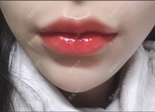 更美 - 更美用户yLBEhTSwEN的玻尿酸套餐经验 | 玻尿酸套餐