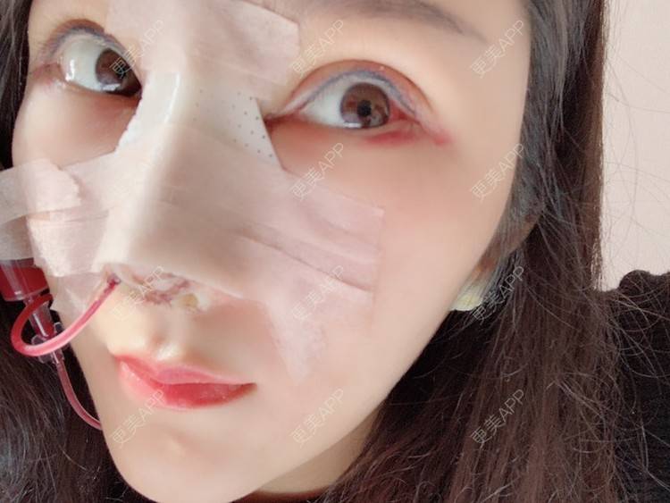 更美 - Angela816的双眼皮经验 | 双眼皮 | 全切双眼皮 | 绍兴