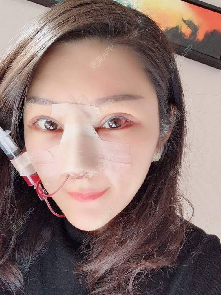 更美 - Angela816的双眼皮经验 | 双眼皮 | 全切双眼皮 | 绍兴