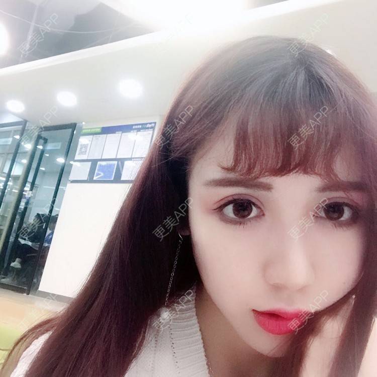 更美 - 更美用户HzCxtYeP3y的胶原蛋白丰面颊经验 | 胶原蛋白丰面颊 | 玻尿酸