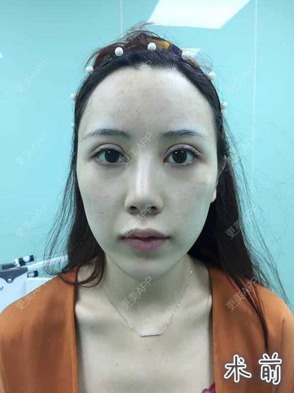 更美 - 更美用户HzCxtYeP3y的胶原蛋白丰面颊经验 | 胶原蛋白丰面颊 | 玻尿酸