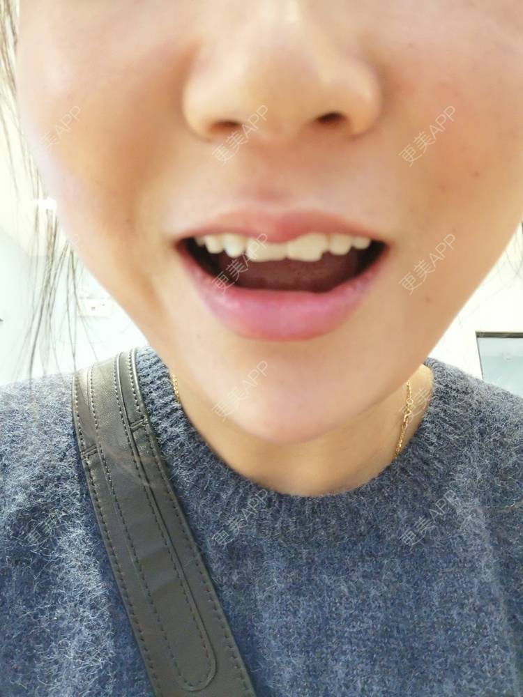 更美 - teresawon的树脂补牙经验 | 树脂补牙 | 上海