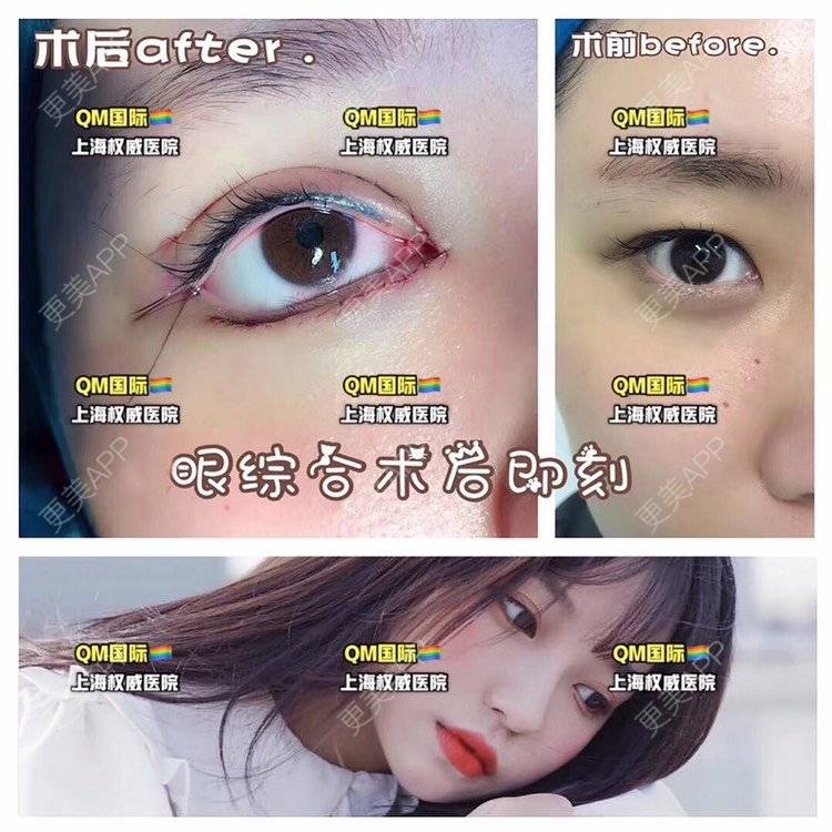 更美 - 祢的美丽/我的职责的全切双眼皮经验 | 全切双眼皮 | 定点双眼皮 | 自体脂肪填充泪沟 | 开内眼角 | 开外眼角 | 上海