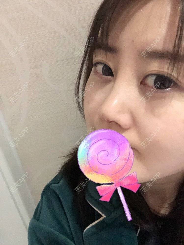 更美 - 🌺💸TingTing🌺的鼻部多项经验 | 鼻部多项 | 自体软骨垫鼻尖 | 鼻部硅胶假体取出