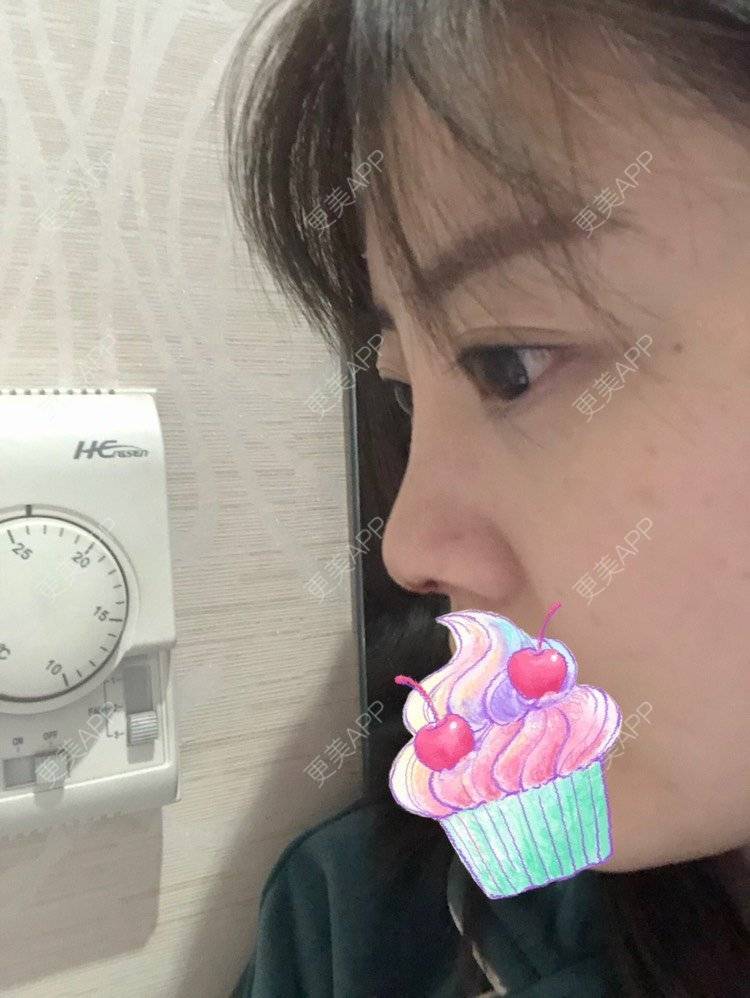 更美 - 🌺💸TingTing🌺的鼻部多项经验 | 鼻部多项 | 自体软骨垫鼻尖 | 鼻部硅胶假体取出