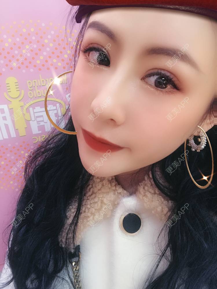 更美 - 卡门小妖精，的玻尿酸卧蚕经验 | 玻尿酸卧蚕 | 重庆 | 自体脂肪丰卧蚕 | 真皮丰卧蚕 | 双眼皮修复 | 眼部多项