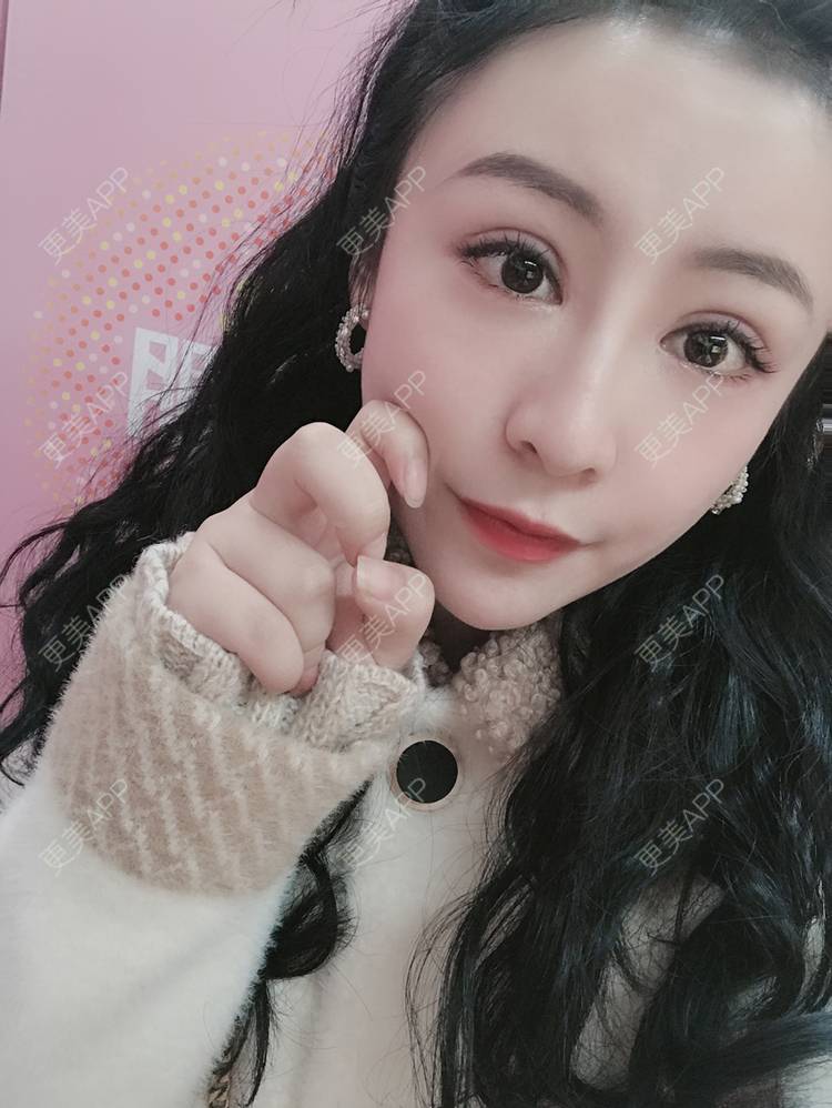 更美 - 卡门小妖精，的玻尿酸卧蚕经验 | 玻尿酸卧蚕 | 重庆 | 自体脂肪丰卧蚕 | 真皮丰卧蚕 | 双眼皮修复 | 眼部多项