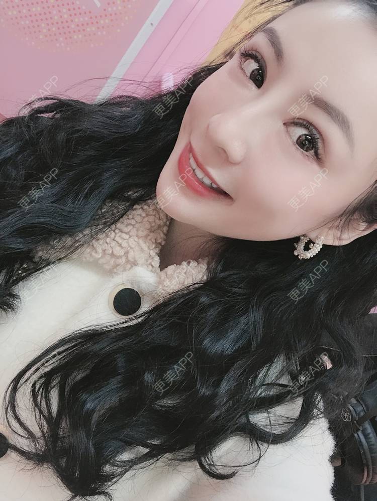 更美 - 卡门小妖精，的玻尿酸卧蚕经验 | 玻尿酸卧蚕 | 重庆 | 自体脂肪丰卧蚕 | 真皮丰卧蚕 | 双眼皮修复 | 眼部多项