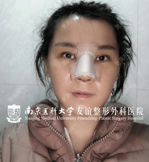 更美 - 王树 医生的鼻部多项经验 | 鼻部多项 | 南京