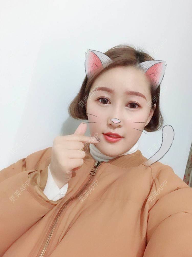 更美 - 小白白0501的膨体隆鼻经验 | 膨体隆鼻 | 合肥