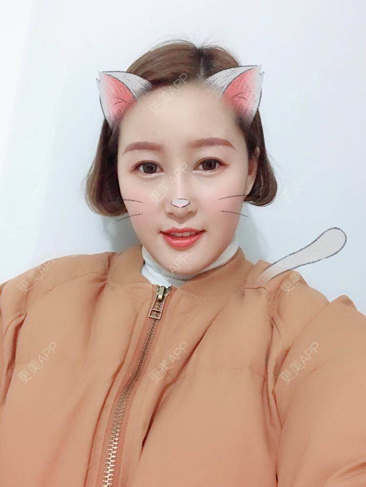 更美 - 小白白0501的膨体隆鼻经验 | 膨体隆鼻 | 合肥