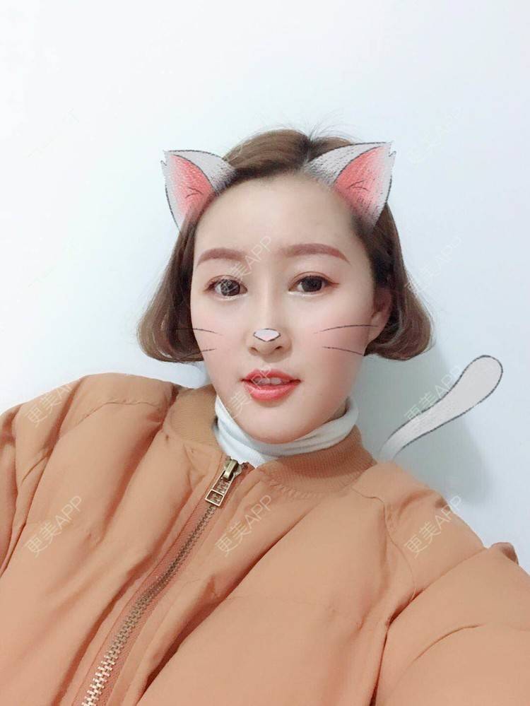 更美 - 小白白0501的膨体隆鼻经验 | 膨体隆鼻 | 合肥
