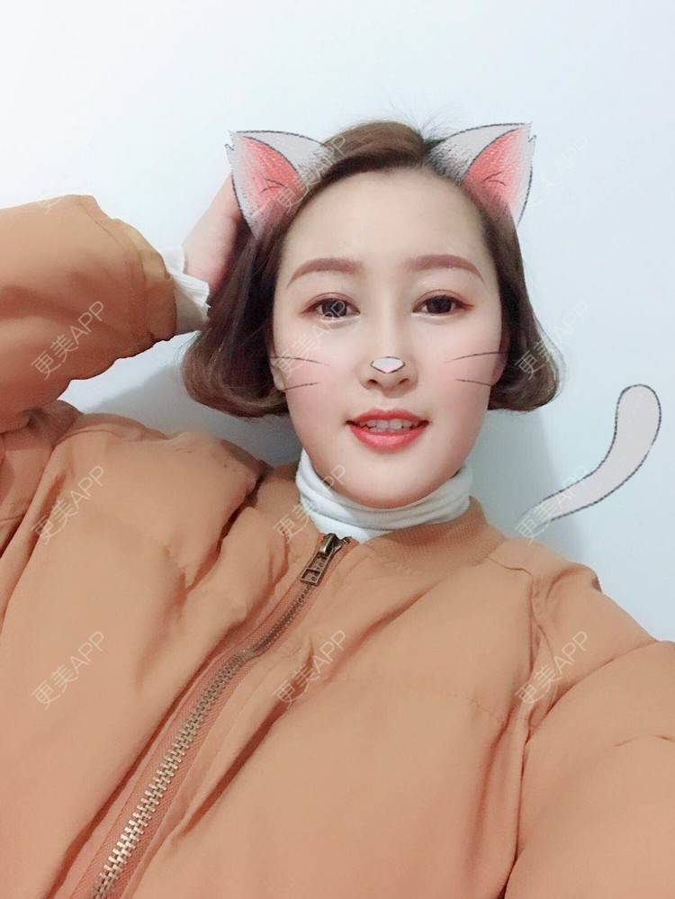 更美 - 小白白0501的膨体隆鼻经验 | 膨体隆鼻 | 合肥