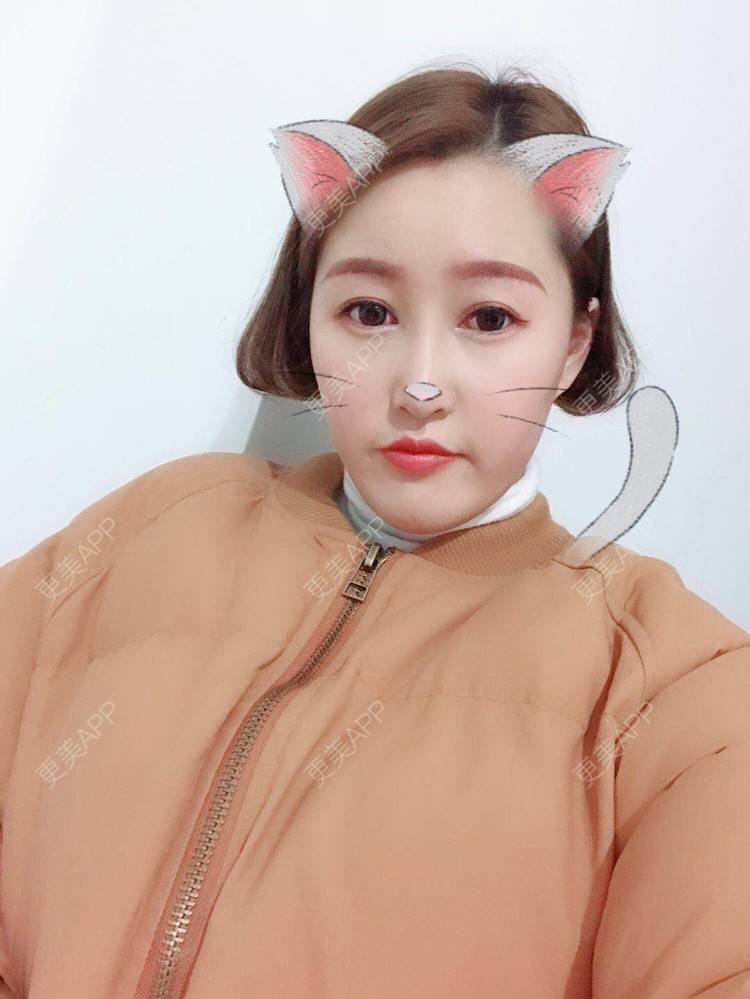 更美 - 小白白0501的膨体隆鼻经验 | 膨体隆鼻 | 合肥