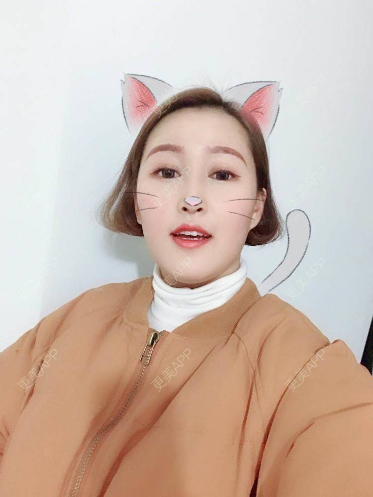 更美 - 小白白0501的膨体隆鼻经验 | 膨体隆鼻 | 合肥