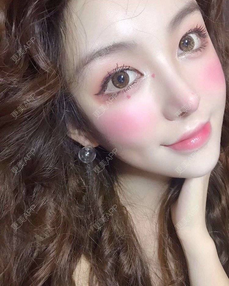 更美 - 祢的美丽/我的职责的全切双眼皮经验 | 全切双眼皮 | 定点双眼皮 | 上海