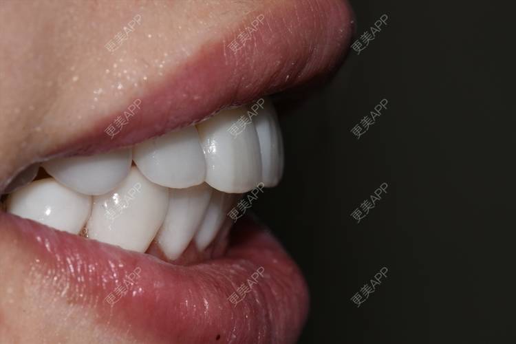 更美 - 更美用户4iLEe1psGi的口腔检查经验 | 口腔检查