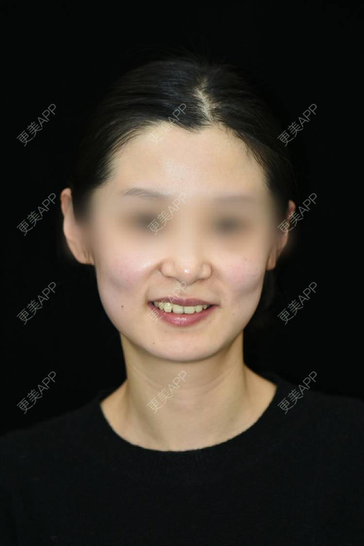 更美 - 更美用户2cJFoLLJL6的口腔检查经验 | 口腔检查