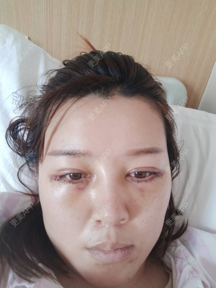 更美 - A孟先生的内切去眼袋经验 | 内切去眼袋 | 苏州