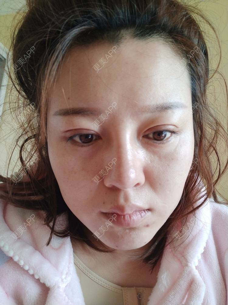 更美 - A孟先生的内切去眼袋经验 | 内切去眼袋 | 苏州