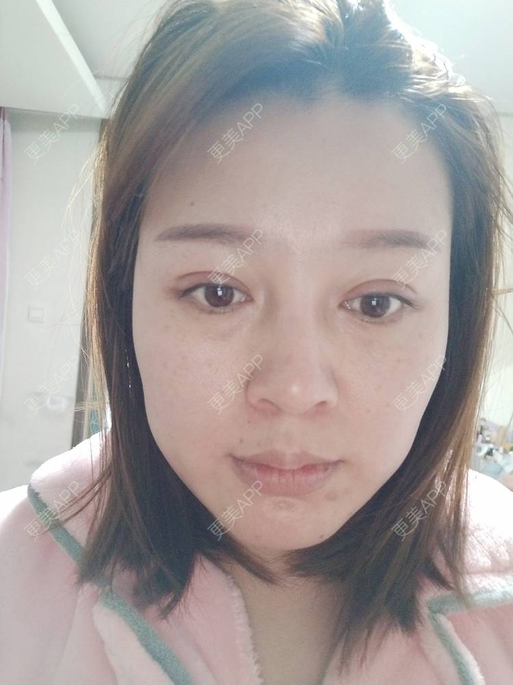 更美 - A孟先生的内切去眼袋经验 | 内切去眼袋 | 苏州