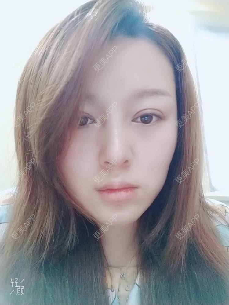 更美 - A孟先生的内切去眼袋经验 | 内切去眼袋 | 苏州