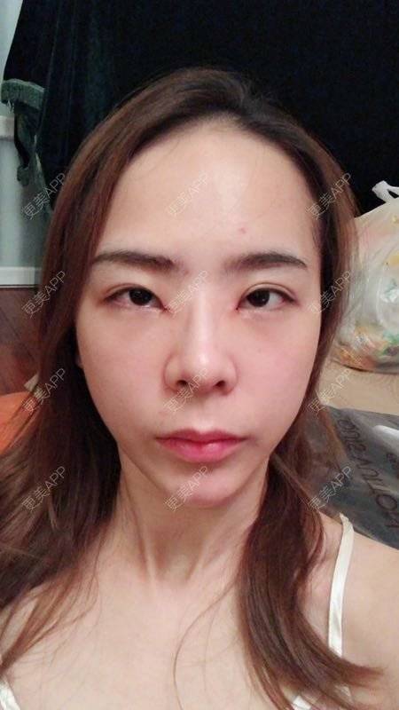 更美 - 更美用户etSzs9RHhY的开眼角修复经验 | 开眼角修复