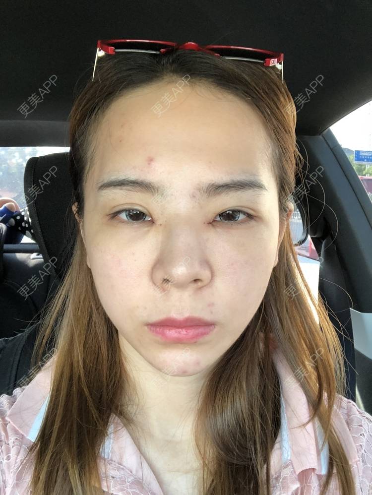 更美 - 更美用户etSzs9RHhY的开眼角修复经验 | 开眼角修复